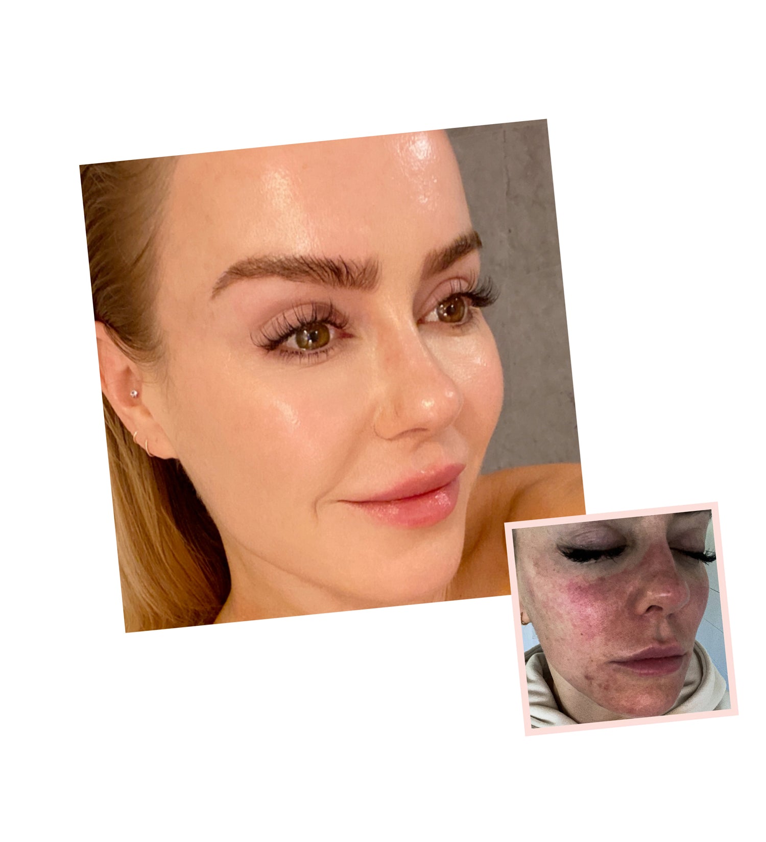 This Cream Erased My Dark Spots Overnight! (Triamcinolone Acetonide) - 43hgt1p